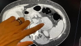 L'AI diagnostica il cancro in modo pi&ugrave; efficace della biopsia? Ecco lo studio rivoluzionario