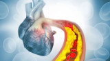 Terapia genica 'one-shot' abbatte colesterolo e trigliceridi: prima sperimentazione umana riuscita